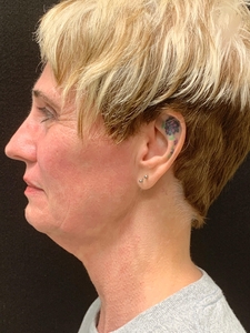 MyEllevate, Facetite, Morpheus8, Nanofat, Sculptra-before