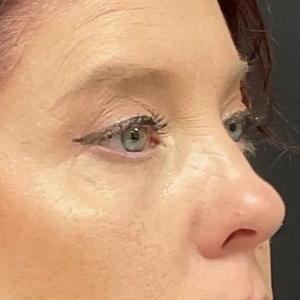 Brow & Eye Lift #4-after