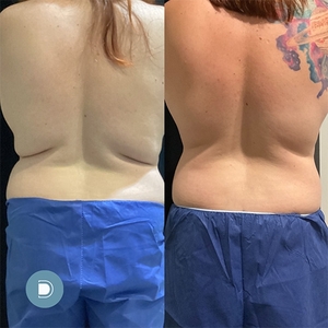 Coolsculpting-before