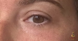 Nouvaderm Laser Treatment- Lower Eye-24 hours Post Treatment-before