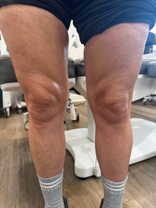 1 Syringe of Radiesse and 1 Sofwave Treatment-before