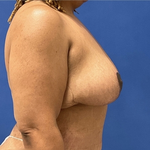 Breast Lift #6-after