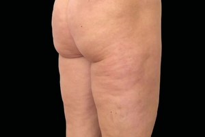 3 Treatments-after