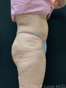Abdominoplasty - Traditional-after