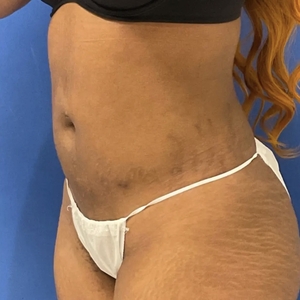 Lipo w Renuvion #10-after