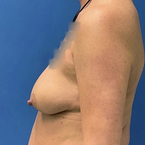 Breast Augmentation #4 450 cc-before