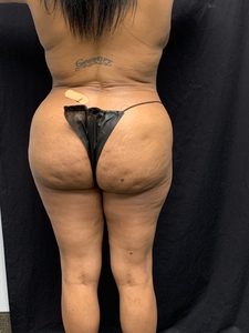 Lipo 360 + BBL-before