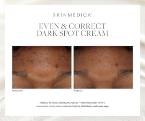 Even & Correct Dark Spot Cream-before