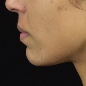 Chin Filler-before