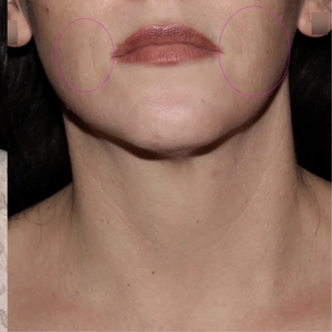 Lipo w Skin Tightening Face #4-after