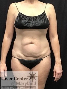 Tummy Tuck w/ vertical slit-before