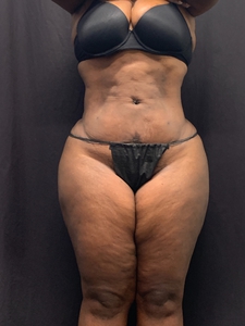 LAL-upper + lower abdomen + avelar tuck-after