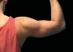 Emsculpt NEO #2-after