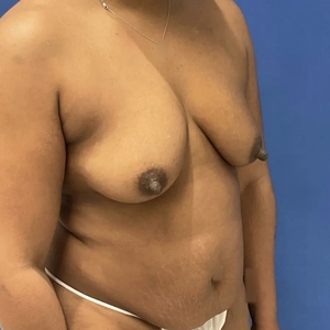 Mommy Makeover #8-before