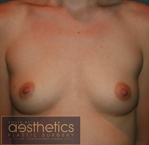 Sientra Round Smooth Gel: 320cc-before