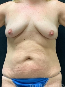 6 weeks post op traditional tummy tuck and breast lift with 390cc teardrop shaped implants-before