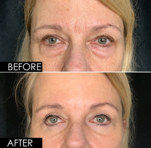 Upper & Lower Blepharoplasty-before