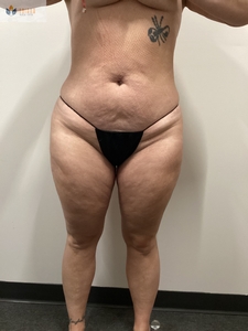 2 insta abd treatments-after