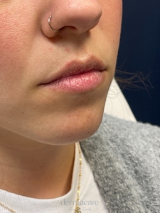 Danielle Glass, RN. - Versa-before