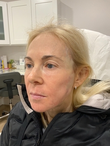 Treatment for wrinkles, pore size, hyperpigmentation, skin tightening-after