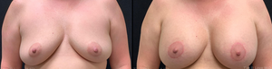 5'4 175lb. One month post op mastopexy augmentation using shaped gel implants-before
