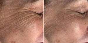 Microneedling-before