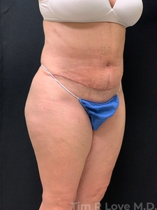 Abdominoplasty - Traditional-after