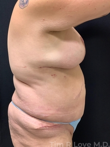 Abdominoplasty - Traditional-after