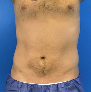 Liposuction #4-after