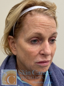 Nova Threads and Cheek Filler-before