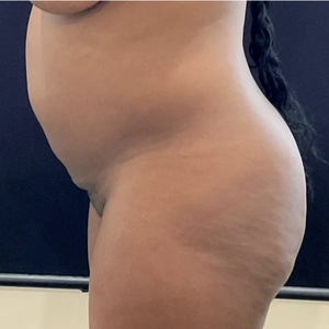 Liposuction #5-before