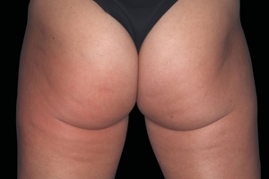 4 Treatments-after