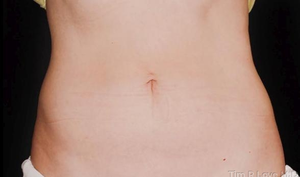 Liposuction - Abdomen-after