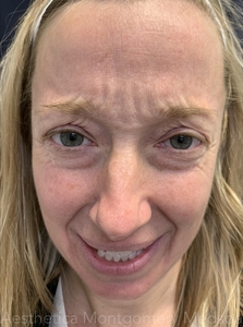 Glabellar complex Jeuveau before and after-before