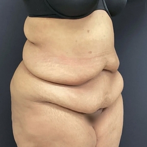 Tummy Tuck #16-before