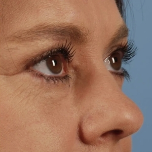 Brow & Eye Lift #5-after