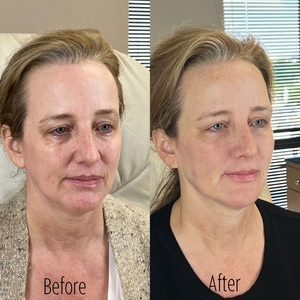 Filler B/A SBA 33-before