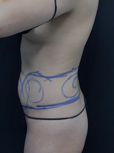 LAL-lower abdomen + waist-before