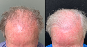 Nanofat/PRP 2000 Hair grafts-before