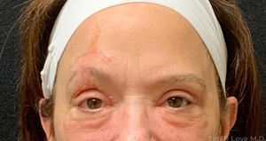 With scar revision and periorbital Morpheus/Fractora-after