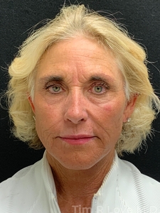 1 year post op short scar facelift, Morpheus 8, Fraxel, Sculptra, Lip filler-after