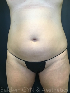 plus lipo 2.0-before