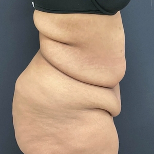 Tummy Tuck #16-before