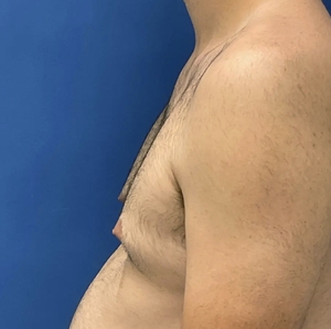 Male Breast Reduction #5 (left)-before