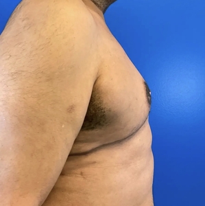 Male Breast Reduction #2-after