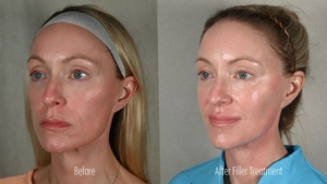 Filler ER B/A Left Oblique-before