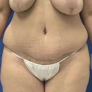 Mommy Makeover #9-after