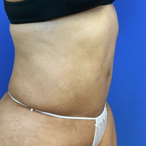 Tummy Tuck #2-after