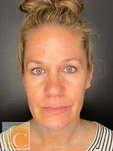 IPL and Botox-after