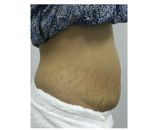 Body Contouring-after